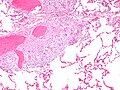 顯微鏡下顯示出肺內結節病性肉芽腫，包含星狀小體，使用HE染色