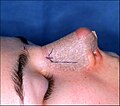 Photograph B. Open rhinoplasty: Post-operative, the taped nose, prepared to receive the metal nasal splint that immobilizes and protects the newly corrected nose.
