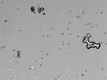 尿液鏡檢顯示一些「一水草酸鈣」結晶(啞鈴狀， some of them clumped) ，一個「二水草酸鈣」結晶(信封狀)和一些血紅細胞。