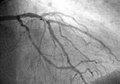 A 心血管照影（英语：coronary angiogram），图中可见左冠状动脉、左前降支动脉，以及左回旋支动脉。