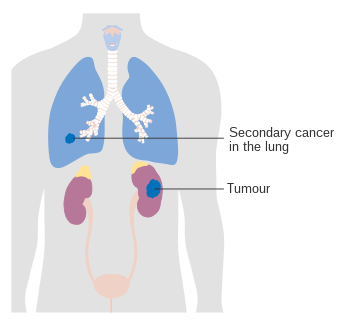 Stage 4 kidney cancer