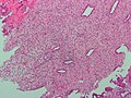 Micrograph of decidualized endometrium due to exogenous progesterone. H&E stain.