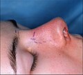Photograph A. Open rhinoplasty: Pre-operative, the guidelines (purple) ensured the surgeon's accurate incisions in cutting the nasal defect correction plan.