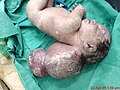 A neonate with a large encephalocele.